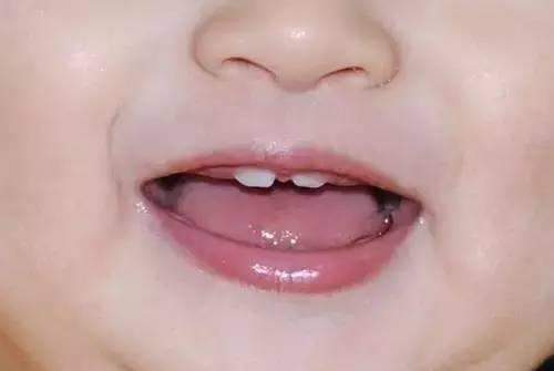 十个月宝宝,上面两个门牙缝隙大,怎么办?-学路