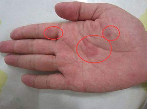 得了结节红斑为什么身上这么痒