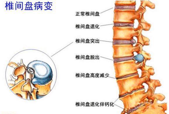 腰椎间盘要怎么治疗效果比较好,注意哪些方法