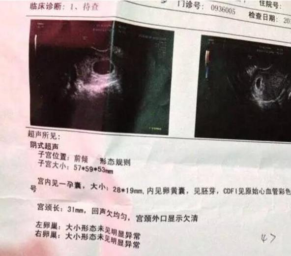 怀孕前三个月如何通过孕囊看男女 方法分享