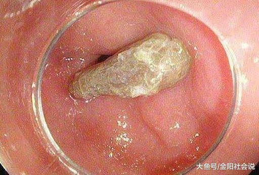 4岁小孙女总说肚子痛, 当医生在肚子取出这东西时, 婆婆看到哭了