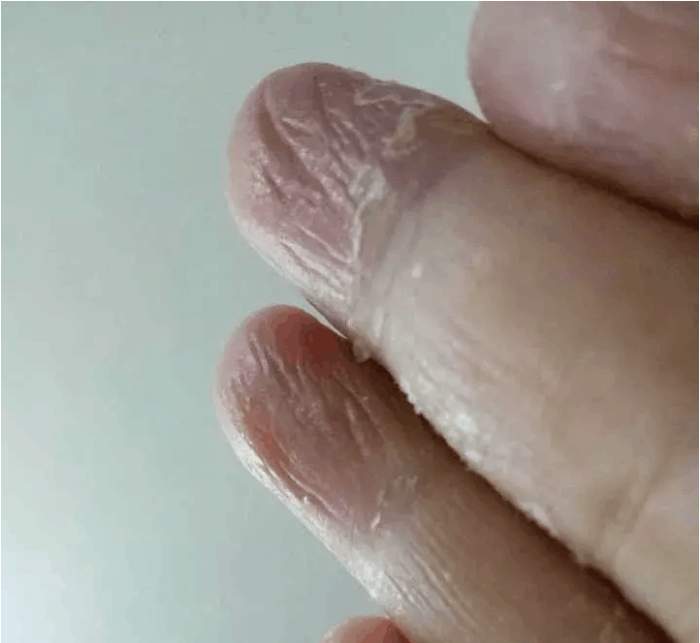 手脚总是出汗是怎么回事?