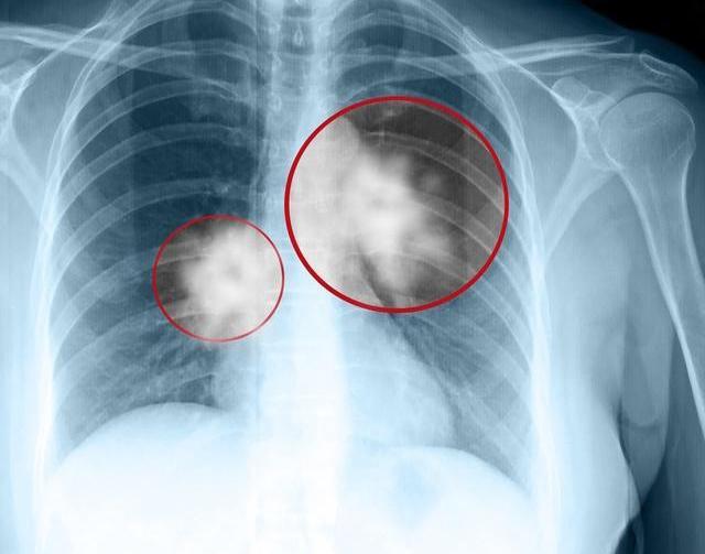 以痰中带血为首发症状的肺癌约占所有肺癌的20,肺癌出现痰中带血一般