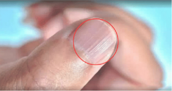 为什么有的人指甲上会出现竖纹，它暗示着什么？看完要留意了