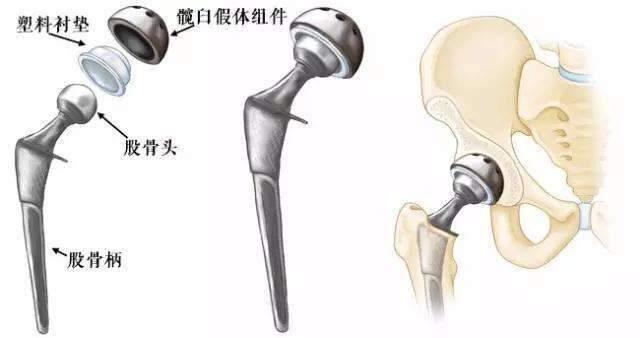 人工髋关节可以用多长时间？人工髋关节的寿命是多久？