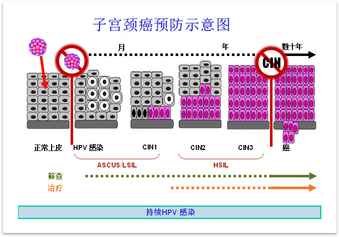 HPV疫苗和筛查结合是最佳的宫颈癌预防方式