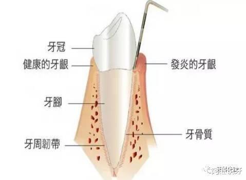 洗牙导致牙龈出血？牙医：这个锅我不背