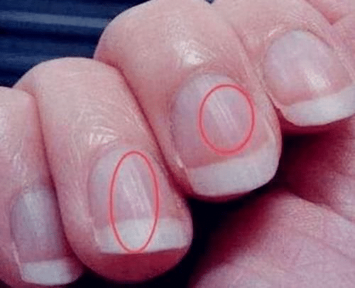 为什么有的人指甲上会出现竖纹，它暗示着什么？看完要留意了