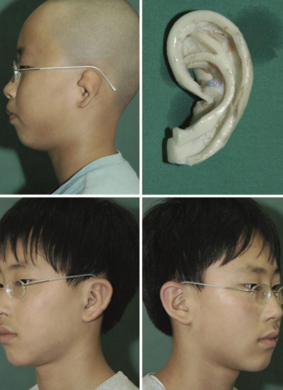 左耳畸形整形怎么治疗？耳再造专家余文林科普