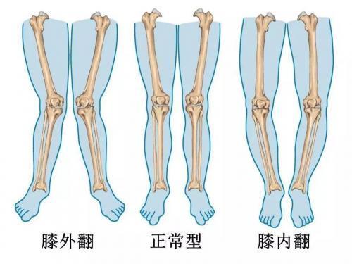 老人的膝关节疼的厉害怎么办？要不要做关节置换？