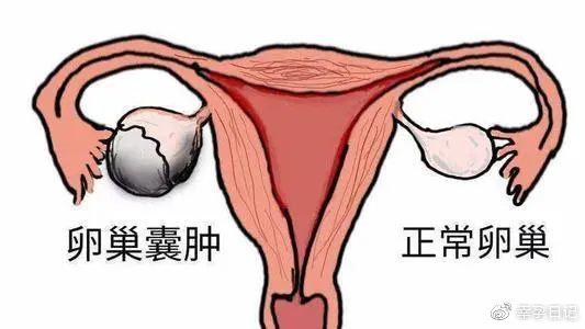 试管婴儿蒙古国试管婴儿ivf生理性卵巢囊肿多久自行消失