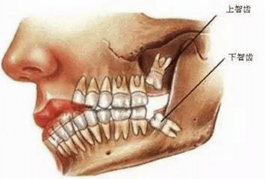 智齿不疼需要拔吗