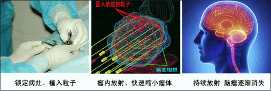 放射治疗的副作用有哪些？能用粒子刀治疗吗