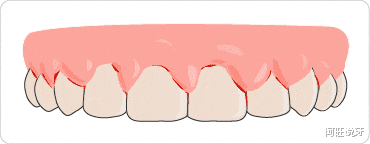 洗牙导致牙龈出血？牙医：这个锅我不背