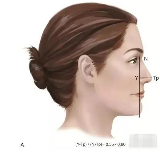 改善鼻尖的手术方法有哪些
