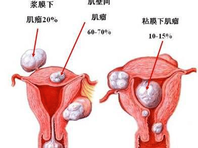 月经不调，痛经，和子宫肌瘤这点事