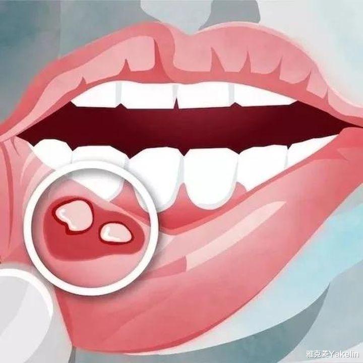 口腔溃疡上为什么有一层白色的膜?可以揭掉吗? 口腔溃疡上为什么有一层白色的膜?可以揭掉吗?