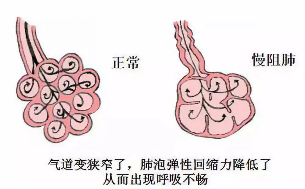 慢阻肺怎么样治疗好 慢阻肺是怎么形成的