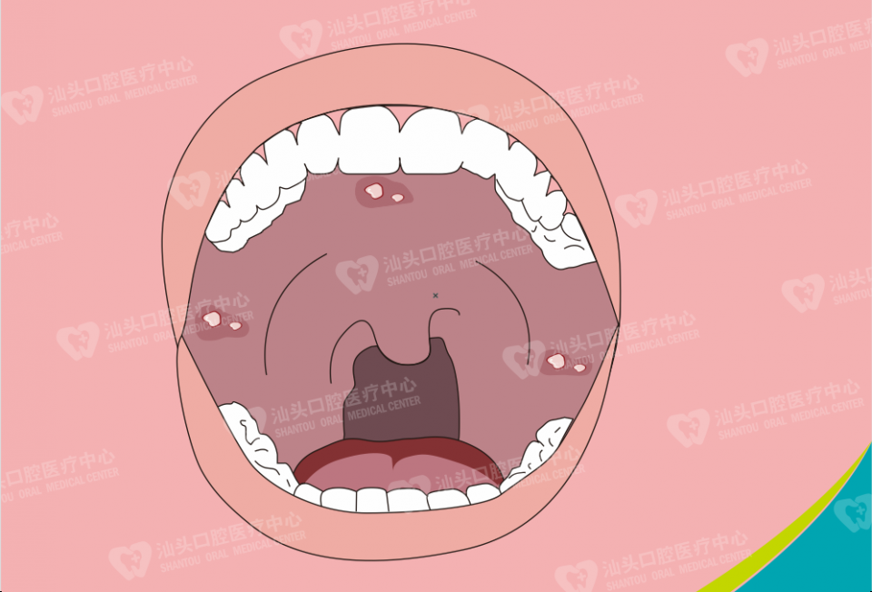 口腔溃疡都有哪些原因导致的？