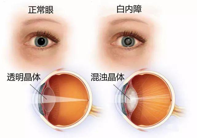 常见的眼部疾病有哪些？别急，看这里