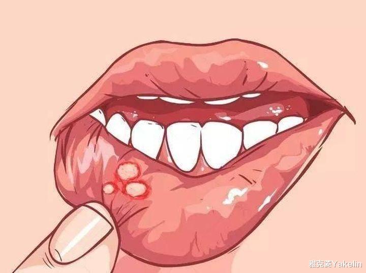 口腔溃疡上为什么有一层白色的膜？可以揭掉吗？