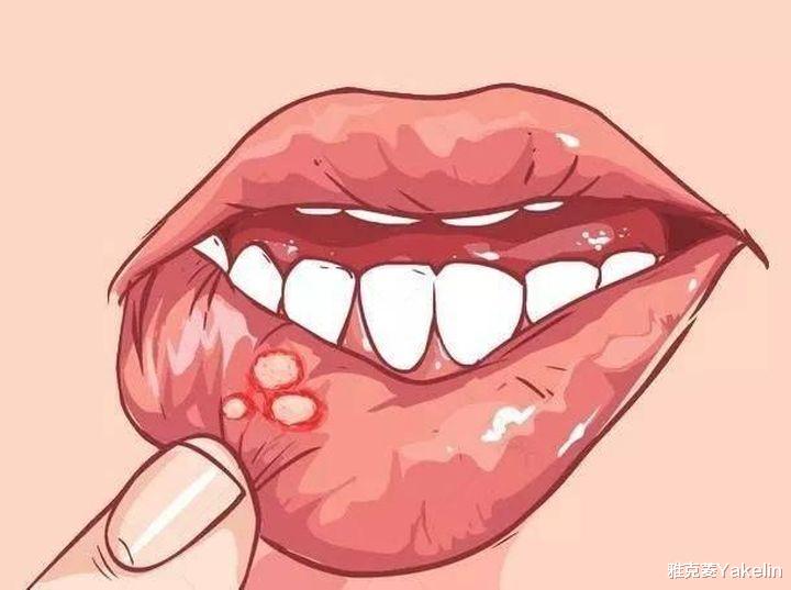 口腔溃疡上为什么有一层白色的膜?可以揭掉吗? 口腔溃疡上为什么有一层白色的膜?可以揭掉吗?