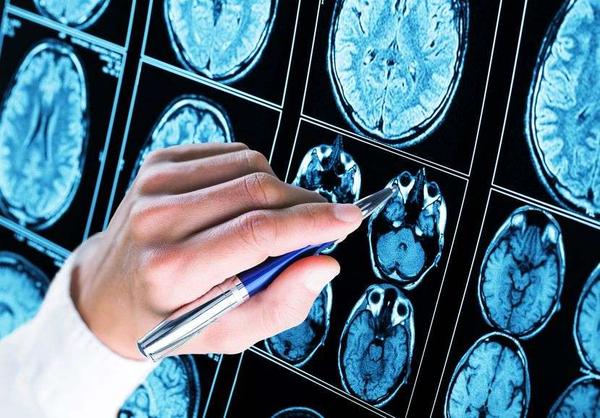 哪些原因会引发脑血管狭窄?医生:这6个因素脱不了关系,需重视 哪些原因会引发脑血管狭窄?医生:这6个因素脱不了关系,需重视