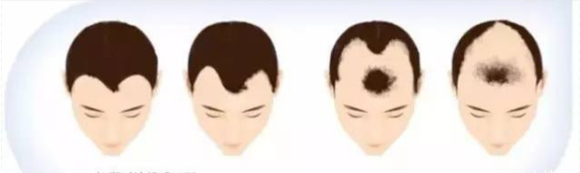 “M”型脱发和“O”型脱发的区别！