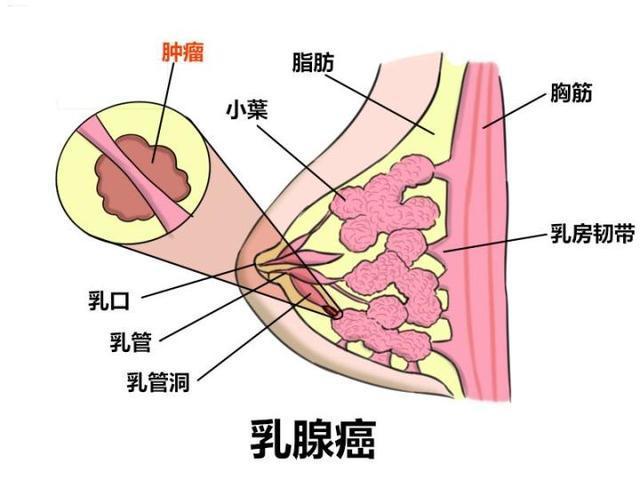 "五大症状"教你发现乳腺病变, 远离"乳腺癌"杀手!