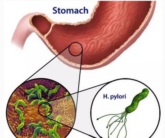 是科学还是谣言, 蒲公英可以根治幽门螺杆菌?