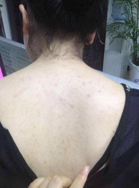 女生后背长"痘痘"太尴尬, 每天坚持吃点它, 轻松祛痘!