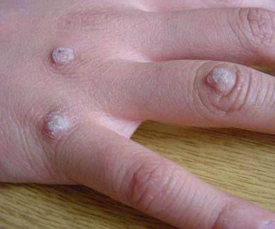 中医治疗瘊子 农村1种庄稼花, 是不花钱的中药