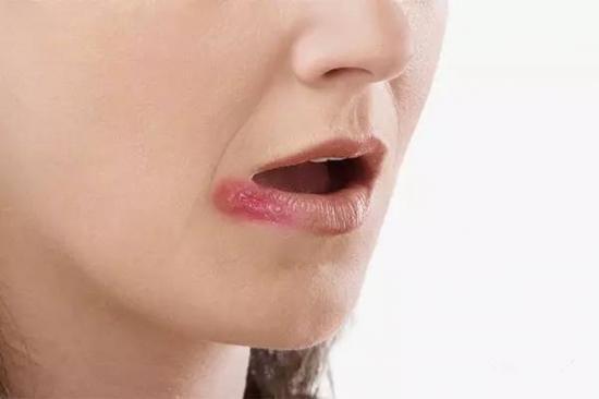 烂嘴角, 只需两滴水就能好, 我们每天都有看到它
