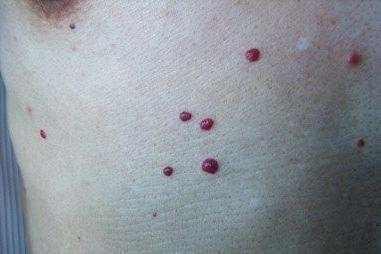 身上长了'小血痣'要重视, 教你用食材泡水喝, 排