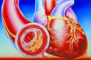 何谓心肌梗死 途牛年轻副总突然离世! 心肌梗死