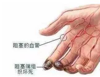 吃什么药可以化解血栓 751133ef620db33e08764cbf54b874c6x323x250x12.jpeg