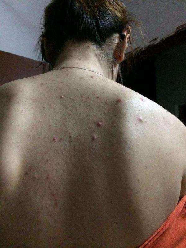 背上长青春痘, 不是青春的表现, 而是湿气排不出来!