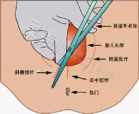 顺产的还要侧切一刀, 为什么啊? 妈妈转给爸爸们看看吧
