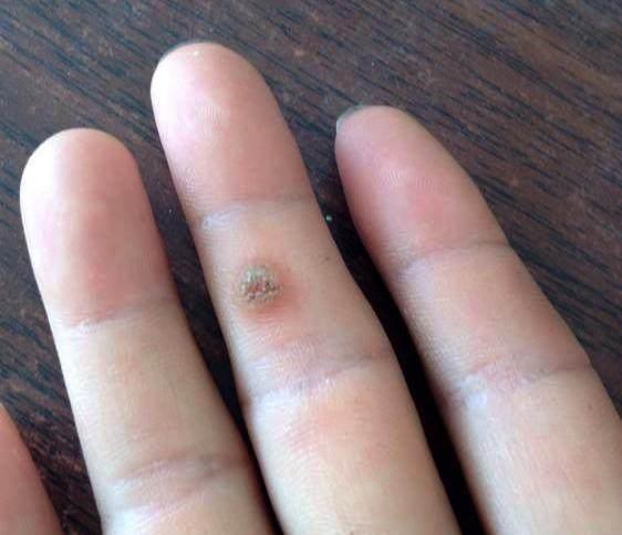 中医治疗瘊子 农村1种庄稼花, 是不花钱的中药