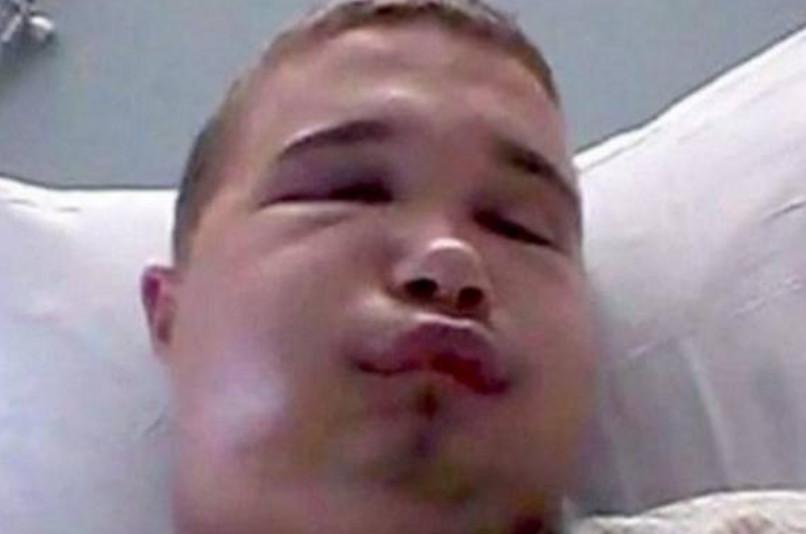 国外一男子酷爱毒蛇, 直播亲毒蛇时不小心被咬, 结果变成“猪头脸”