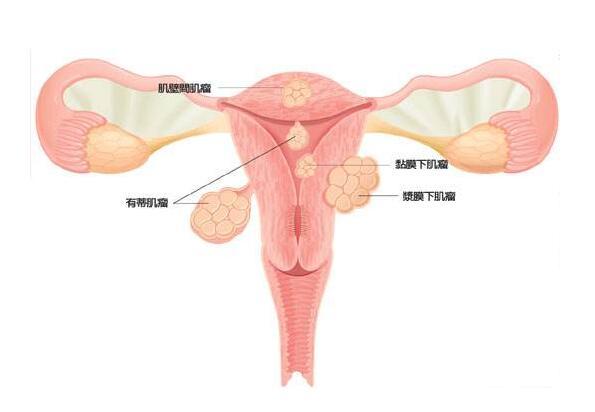 子宫肌瘤并没有你想象中那么可怕!