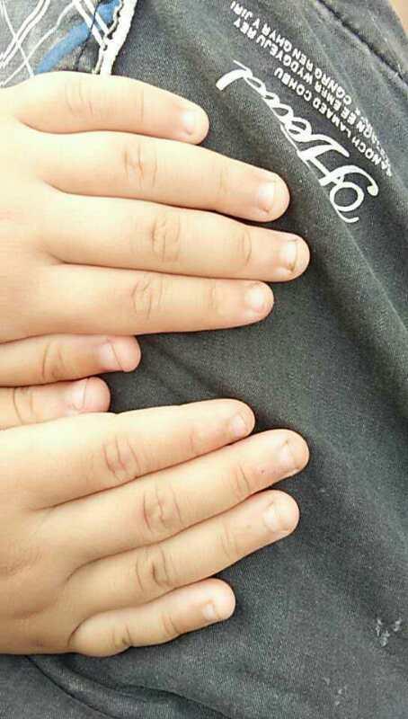 孩子被幼儿园老师把指甲剪了, 半年都没长出来, 幼儿园不负责