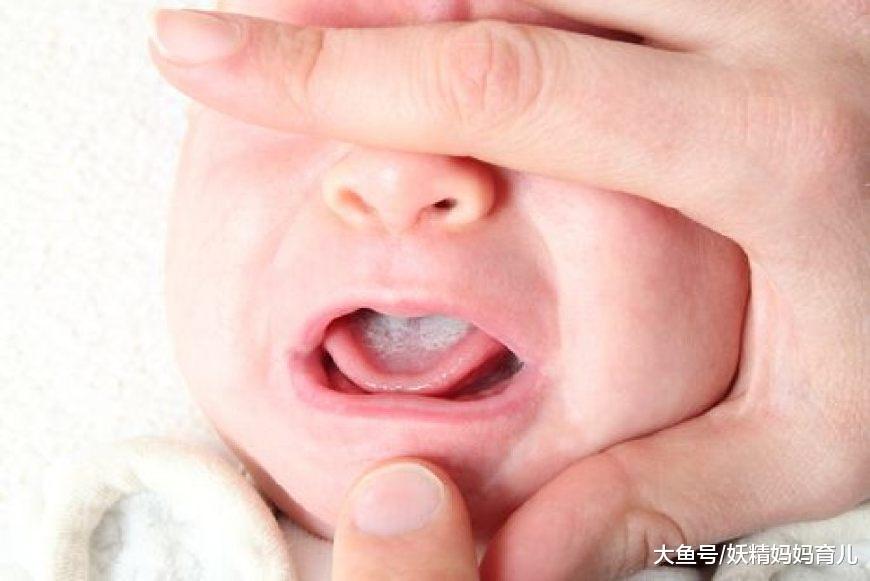 宝宝鹅口疮有哪些特征? 护理鹅口疮宝宝的4个小妙招 值得一试