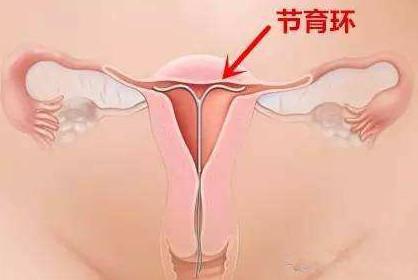 为什么不建议女人上环, 看完这些你就明白了