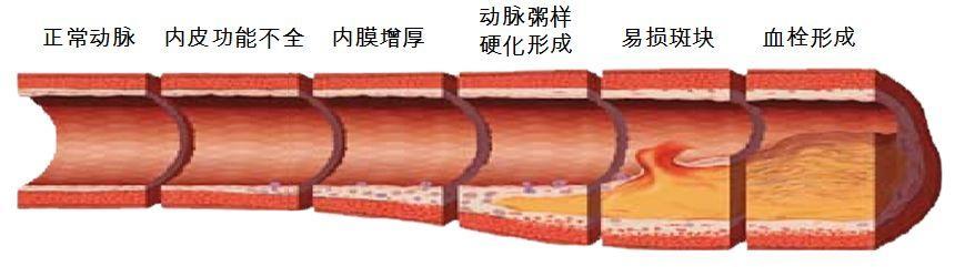 这些人容易被血栓“拴住”, 一个小动作, “冲洗”血管, 远离血栓!
