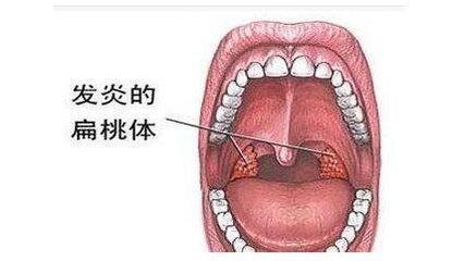 孩子容易扁桃体发炎,化脓, 试试夏枯草煮水喝.