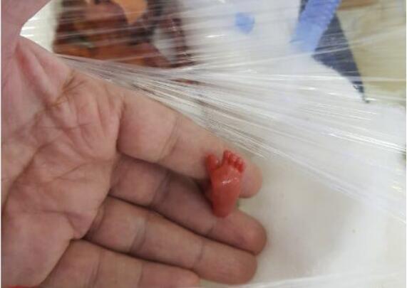 宝宝出生只有400克, 迷你宝宝顽强生存 见证生命奇迹