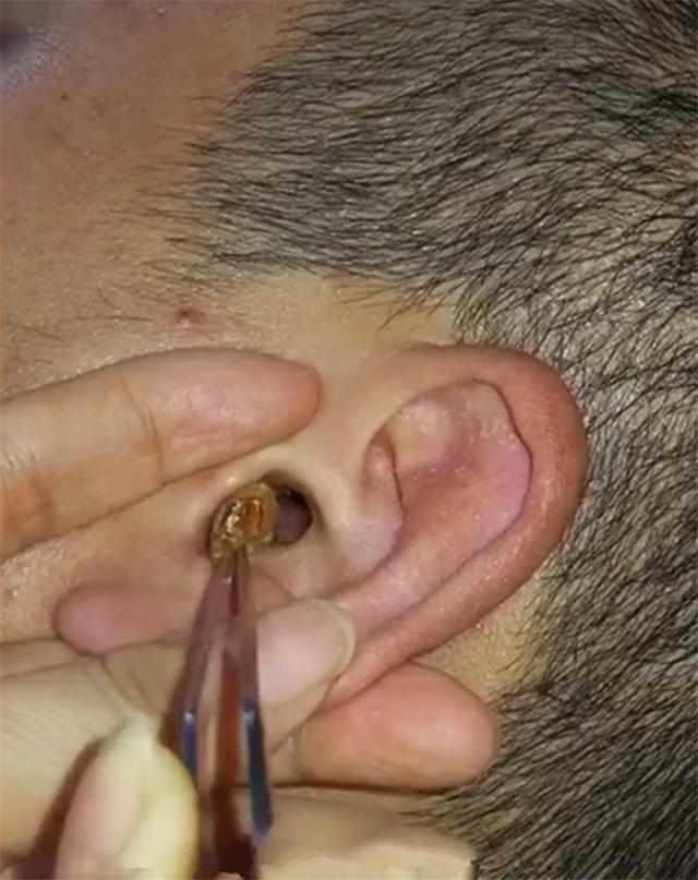 总觉得耳洞里涨, 男子请人掏耳朵, 从里面拽出一条“大黄虫”