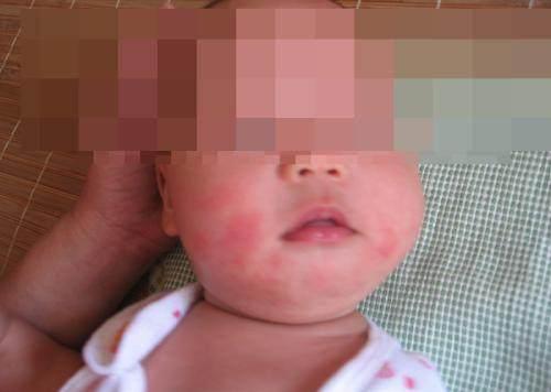 满月宝宝奶癣总不好, 二胎妈妈教你奶癣宝宝护理3要点