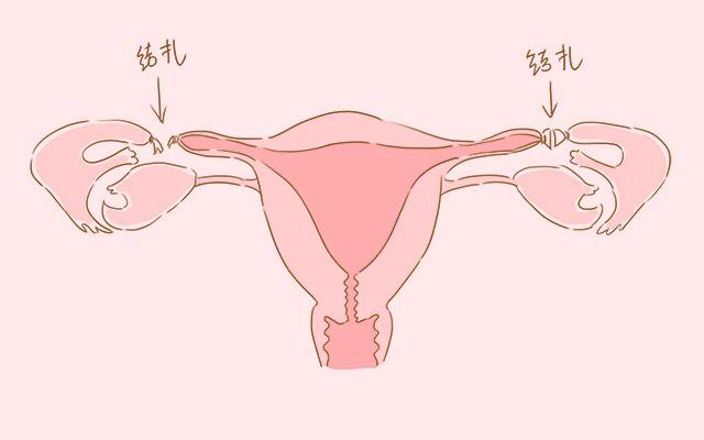 二胎后你会选择结扎还是上环? 这些方式对女性的影响你知道吗?
